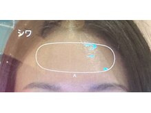 肌測定はしっかり必要な本数の鍼を的確に打つために行います！