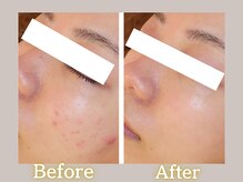 ハル(HARU.)/HARU.式ハーブピーリング7回