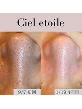 シエルエトワレ/毛穴エクストラクション