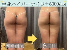 スリムプロ 天王寺店(Slimpro)/全身ハイパーナイフ＋6000shot