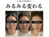 【小顔矯正+美肌美顔器8回モニターコース】通常￥88,000→モニター￥44,000
