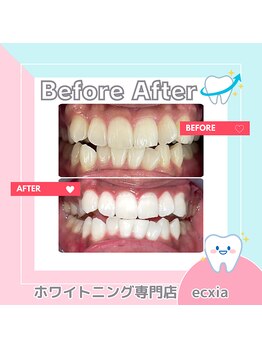 エクシアホワイトニング 札幌中島公園店/BeforeAfter［ホワイトニング］ 
