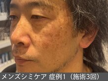 オアシスラグーン(OASIS LAGOON)/メンズシミケア（症例1施術3回）