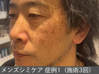 オアシスラグーン(OASIS LAGOON)/メンズシミケア(症例1施術3回)