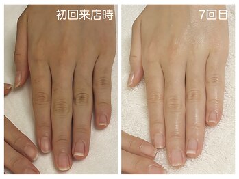 キレイテ 上野店/30代/7回目【ハンドケア上野】