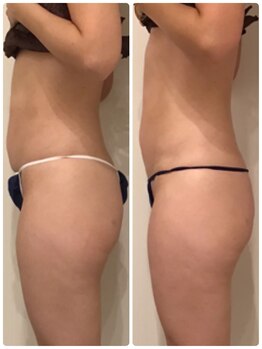 ファビリス 天王寺店(FAVILIS)/ハイパーナイフ1回/30代