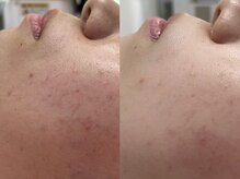 ソルシエール/プチフェイシャル