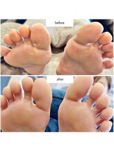 ケアプラス(care plus)/足裏角質ケア