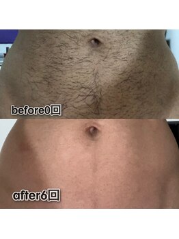 ボウイズ 磐田店(BOYZ)/お腹脱毛　6回　before after