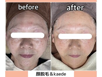 ベルミーランド 浜松天王/フェイシャルBefore→After