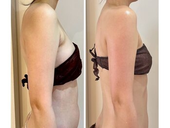 エイシスグロウ(asis glow.)/効果写真