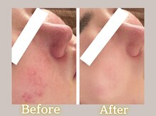 ハル(HARU.)/HARU.式ハーブピーリング10回