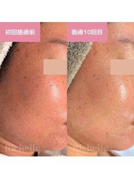 リシェル(Richelle)/ 【GREENPEELソフト1day】