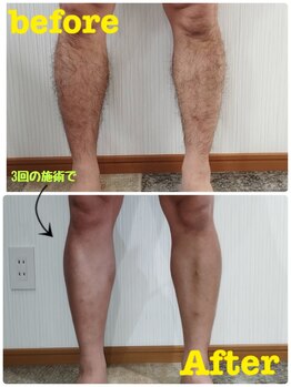 アリス(Alice)/脱毛 メンズ 膝下