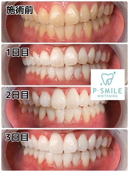 ホワイトベース(White Base)/before after