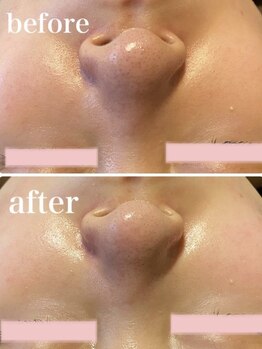 スローティー(Slowty)/ハイドラフェイシャル導入!