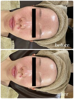 ジャスミン(Jasmin)/ダブルピール×イオン導入