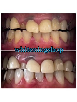 ホワイトニングショップ 豊橋店(WHITENING SHOP)/Before&After豊橋ホワイトニング