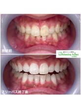 ホワイトニングサロン 名古屋駅店/【ホワイトニング施術例】