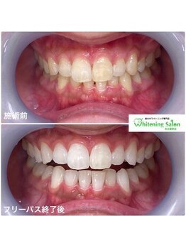 ホワイトニングサロン 名古屋駅店/【ホワイトニング施術例】