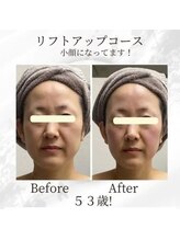 ミヤビ(MIYABI)/低周波リフト