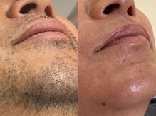 ビム(BIM)/光脱毛/ヒゲ脱毛/東大和市