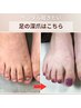 【足の深爪】フット深爪矯正◎サンダルでも見せられる清潔感ある足元へ 