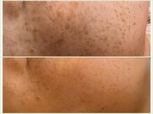 ウェヌ(VENE)/シミもキレイに★