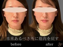 チョコバリ 恵比寿店(chocobari)/小顔リフトアップ（美容鍼）30代