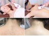 エステ以上【美療全身脱毛】アレキサンド脱毛は驚異の抜け＆くすみ、毛穴ケア