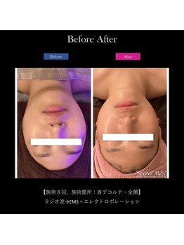 エラ(Ella)の写真/【韓国水光肌へ！ハリ艶アップ、キュッと引き締まった美肌フェイシャル】￥14500→￥8700