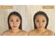 モモスパ(MOMOspa.)/頭蓋骨小顔矯正ビフォアフター