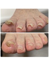 アモーレ プラス トゥエンティフォー(Amore +24)/巻き爪ケア