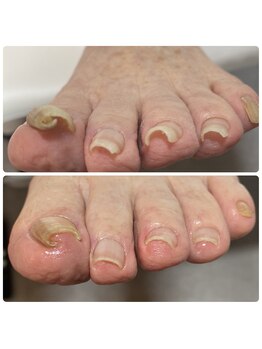 アモーレ プラス トゥエンティフォー(Amore +24)/巻き爪ケア