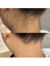 ユウユウ(YUYU)/襟足(Mパーツ)艶の極み脱毛