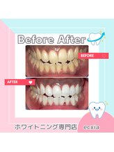 エクシアホワイトニング 札幌中島公園店/BeforeAfter［ホワイトニング］ 