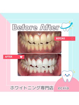 エクシアホワイトニング 札幌中島公園店/BeforeAfter［ホワイトニング］ 