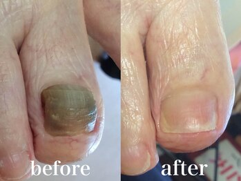 ドクターネイル爪革命 札幌本店/症例紹介4 肥厚爪