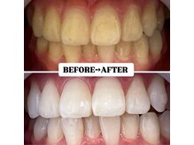 ホワイトニングサロン 宝塚/Before&After美白ホワイトニング