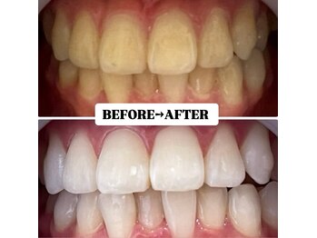 ホワイトニングサロン 宝塚/Before&After美白ホワイトニング