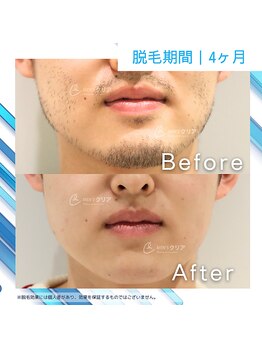 メンズクリア 沼津イーラde店/【メンズクリア】お客様の施術例