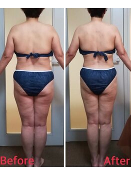 ダイエット サポート(DIET SUPPORT)/短期&グロッティ 施術結果