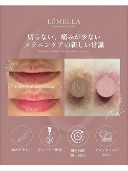 月あかり 星ヶ丘の写真/【星ヶ丘エリア希少◎】ルメラ導入店!女性のデリケートなメラニンケアも女性スタッフが丁寧にご対応◎