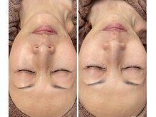 シエル ブルー(Ciel Blue)/肌質改善コース◎光フェイシャル