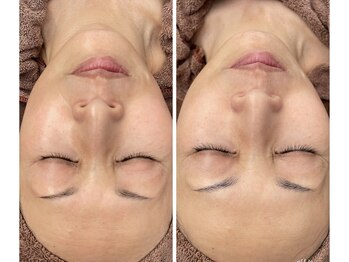 シエル ブルー(Ciel Blue)/肌質改善コース◎光フェイシャル