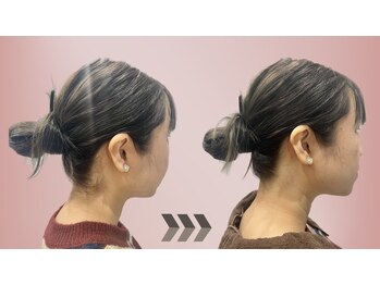 ココ(Coco)/うなじ脱毛