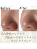 毛穴の汚れつまりにお悩みの方◎マッドケアパック付き￥14,000
