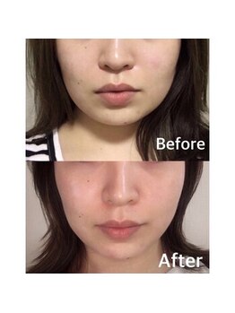 5つ星/◆小顔矯正 1回