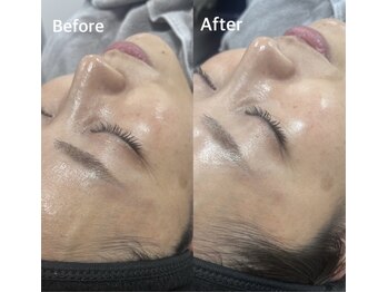 リアン(Lien)/《ララピール》Before/After