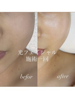 レユシール reussir/光フェイシャル【お肌の改善】